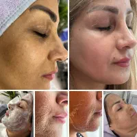 مدل پاکسازی صورت و فیشیال فوری فقط هزینه مواد|خدمات آرایشگری و زیبایی|اهواز, پردیس دو|دیوار