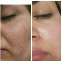 روغن تراپی انواع روغن های درمانی برای مشکلات پوستی