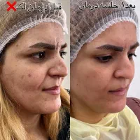 ریموتتوروشن کردن نواحی تیره درمان لک