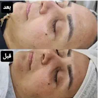 روشن سازی پوست تضمینی با تخفیف ویژه