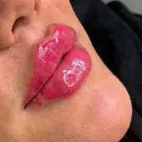 مدل ژل و بوتاکس