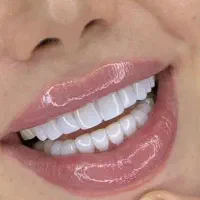 کامپوزیت دندان با متریال ۵۰٪ تخفیف مدلSolafil
