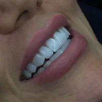 کامپوزیت دندان واحدی ۵۰۰ به مدت ۳روز