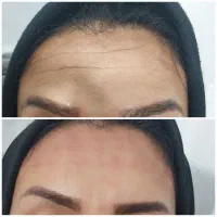 تخفیف ویژه‌ی خدمات ژل و بوتاکس بع مدت محدود|خدمات آرایشگری و زیبایی|ایذه, |دیوار