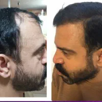 (تخفیف استثنایی کاشتمو)۱۳میلیون(بهعلت قطعیاینترنت)