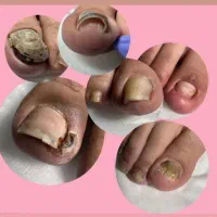 نیازمند مدل برای درمان ناخن پا در کلینیک لوتس