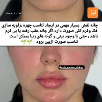 جشنواره/فیلر/بوتاکس/آنزیم/تخفیف دکترفیروزی|خدمات آرایشگری و زیبایی|شیراز, زرهی|دیوار