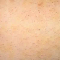 اپیلاسیون کل بدن