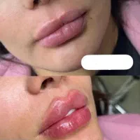 تزریق ژل و فیلر بوتاکس پک مادلینگ با تخفیف فقط890