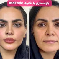 ژل لب روسی بوتاکس کانتورینگ و مادلینگ صورت لیفت نخ|خدمات آرایشگری و زیبایی|تهران, آسمان|دیوار