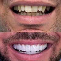 تخفیف کامپوزیت ونیر دندان|خدمات آرایشگری و زیبایی|اردبیل, |دیوار