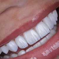 کاشت ایمپلنت با شرایط اقساطی ویژه