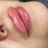 جشنواره ی تزریق بوتاکس و ژل و جوانسازها (هایفو،RF)|خدمات آرایشگری و زیبایی|تهران, نیلوفر|دیوار