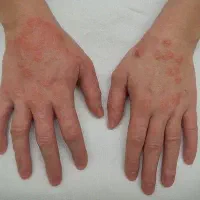 رفع مشکلات پوست و مو|آرایشی، بهداشتی، درمانی|بندر ترکمن, |دیوار