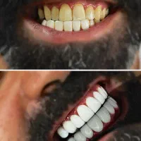جشنواره تخفیف کامپوزیت دندان / مواد درجه یک|خدمات زیبایی و سلامت|کرج, کرج نو|دیوار