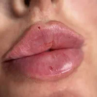 ژل لب روسی جشنواره بوتاکس لیزر بدن مید فیس کرج|خدمات زیبایی و سلامت|کرج, گوهردشت|دیوار