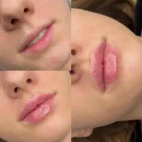 ژل و بوتاکس