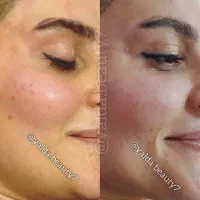 تزریق ژل و بوتاکس|خدمات آرایشگری و زیبایی|بابل, |دیوار