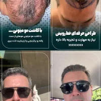 کاشت مو فقط 8700|خدمات آرایشگری و زیبایی|شیراز, معالی‌آباد|دیوار