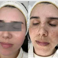 جشنواره درمان تضمینی کک و مک/ زگیل / فقط در 1 جلسه|خدمات آرایشگری و زیبایی|اصفهان, باتون|دیوار