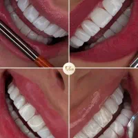 دندانپزشکی و زیبایی بدون پیش پرداخت|خدمات آرایشگری و زیبایی|قم, نوقطار|دیوار