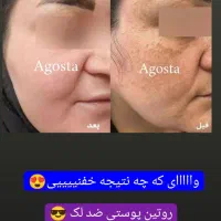 سرم نیاسینامید ضد لک وجوش|آرایشی، بهداشتی، درمانی|شیراز, باغ تخت|دیوار