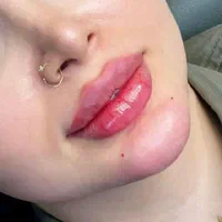 ژل.بوتاکس.مزوژل.لیزر.فیلرچشم