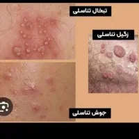 زگیل تناسلیhpv و مشکلات جنسی|خدمات آرایشگری و زیبایی|مینودشت, |دیوار