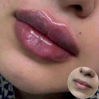 ژل و بوتاکس