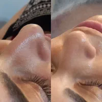 پاکسازی پوست و فیشال رامسر