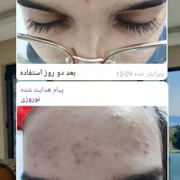 مشکلات پوستیی پسوریازیس لک و...تضمینی