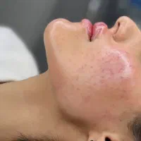 ژل،بوتاکس،مزوتراپی،مزونیدلینگ|خدمات آرایشگری و زیبایی|دوگنبدان, |دیوار