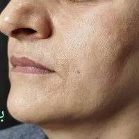 لیفت وجوانسازی قوی صورت