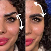 لیفت دایرکت ابرو/لیفت شقیقه