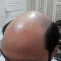 پروتز و ترمیم موی افشان|خدمات آرایشگری و زیبایی|مشهد, کوثر|دیوار