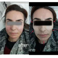 تزریق ژل بوتاکس