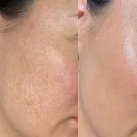 مدل برای تکمیل آلبوم لاین تخصصی پوست|خدمات زیبایی و سلامت|کرج, مهرویلا جنوبی|دیوار