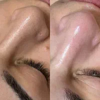 تخفیف ویژه فیشال و پاکسازی پوست