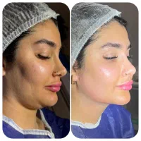 ابدومینوپلاستی/لیپو ساکشن/ماموپلاستی /ژینکو ماستی