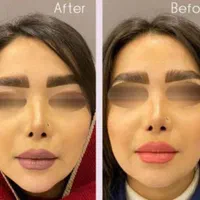 تزریق ژل و بوتاکس|خدمات آرایشگری و زیبایی|تهران, عبدل‌آباد|دیوار