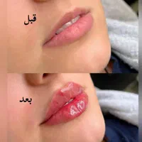 تزریق بوتاکس ژل فیلر|خدمات آرایشگری و زیبایی|تهران, صادقیه|دیوار