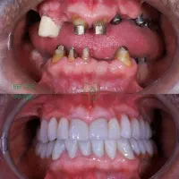 ایمپلنت دیجیتال و اوردنچر اقساطی بدون سود