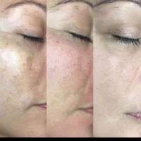 فیشیال و پاکسازی تخصصی پوست|خدمات آرایشگری و زیبایی|قم, قلعه کامکار|دیوار