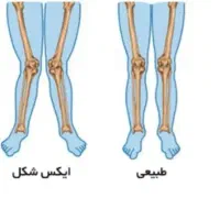 مرکز تخصصی اصلاح غیرجراحی انحرافات زانو|خدمات آرایشگری و زیبایی|بهار, |دیوار