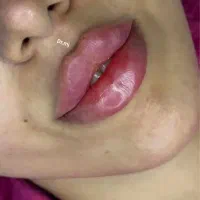 ژل لب 790 بوتاکس چشم گربه ای 290.بوتاکس۶۵۰ میدفیس|خدمات زیبایی و سلامت|مشهد, احمدآباد|دیوار