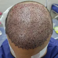 جذب نیرو کاشت مو