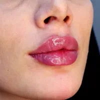 لیزر ژل فیلر بوتاکس پی آر پی قدس