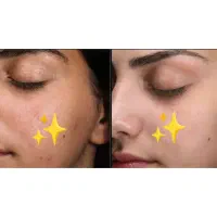 فیشیال صورت