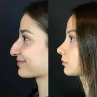 جراحی بینی با شرایط پرداخت ویژه