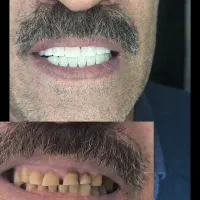 کامپوزیت دندان|خدمات آرایشگری و زیبایی|دورود, |دیوار